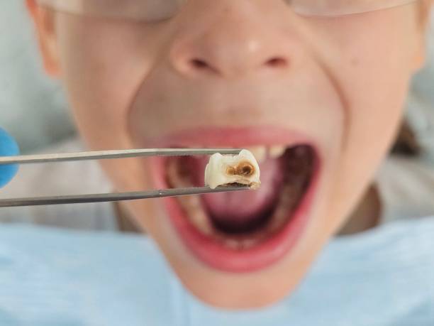 Best Emergency Tooth Extraction  in Milford, DE